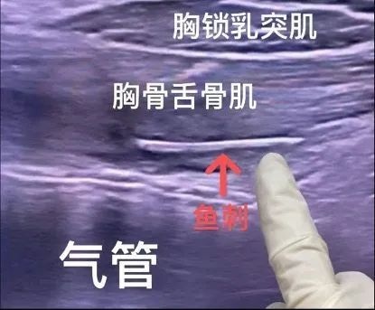 除夕夜20名患者紧急就医，17根鱼刺卡喉！你吃鱼时注意了吗？  第2张