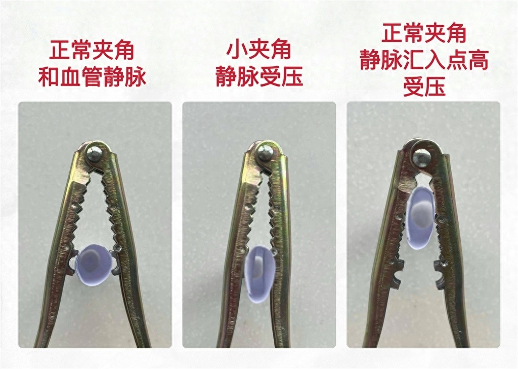 14岁男孩尿液呈粉色！竟是胡桃夹综合征？这是什么病？